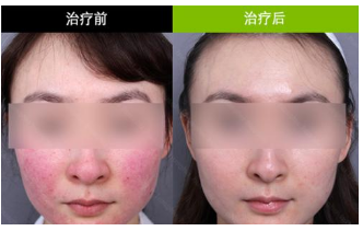 南京激光去红血丝效果好吗?