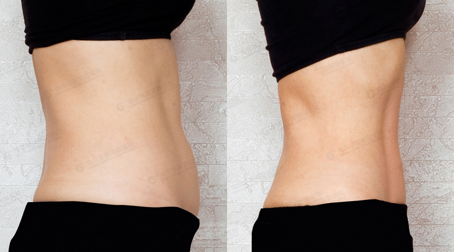 南京做腹部吸脂减肥什么时候见效