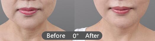 南京笑的时候有皱纹怎么祛除?